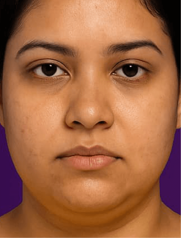 before-image