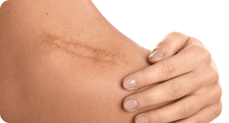 ScarSilc Advanced Silicone Gel for Scars